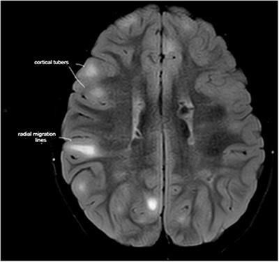 Behavioral Symptoms May Correlate With the Load and Spatial Location of Tubers and With Radial Migration Lines in Tuberous Sclerosis Complex
